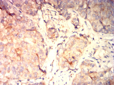 Figure 5: Immunohistochemical analysis of paraffin-embedded bladder cancer tissues using TSLPR mouse mAb with DAB staining.