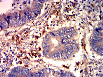 Figure 7: Immunohistochemical analysis of paraffin-embedded rectal cancer tissues using CD40 mouse mAb with DAB staining.