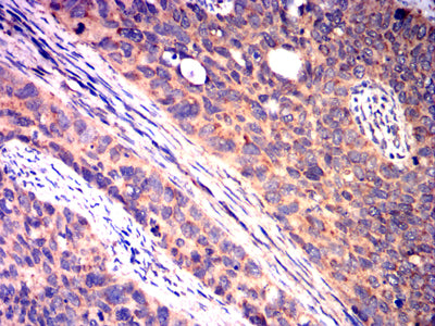 Figure 6: Immunohistochemical analysis of paraffin-embedded cervical cancer tissues using CD40 mouse mAb with DAB staining.