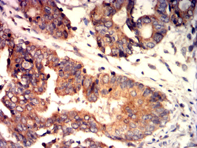 Figure 6: Immunohistochemical analysis of paraffin-embedded rectal cancer tissues using CXCL16 mouse mAb with DAB staining.