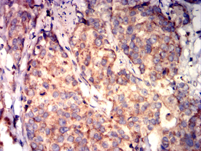 Figure 5: Immunohistochemical analysis of paraffin-embedded bladder cancer tissues using CXCL16 mouse mAb with DAB staining.