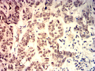 Figure 8: Immunohistochemical analysis of paraffin-embedded lung cancer tissues using C-MYC mouse mAb with DAB staining.