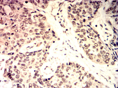 Figure 7: Immunohistochemical analysis of paraffin-embedded esophageal cancer tissues using C-MYC mouse mAb with DAB staining.