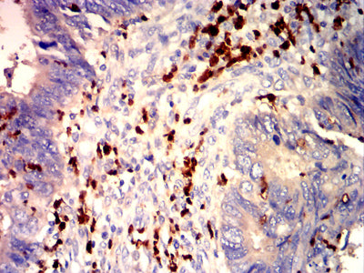 Figure 5: Immunohistochemical analysis of paraffin-embedded rectal cancer tissues using ARG1 mouse mAb with DAB staining.