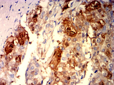 Figure 4: Immunohistochemical analysis of paraffin-embedded liver cancer tissues using ARG1 mouse mAb with DAB staining.