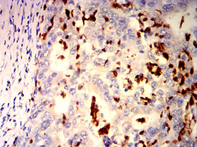 Figure 7: Immunohistochemical analysis of paraffin-embedded Stomach cancer tissues using ARG1 mouse mAb with DAB staining.