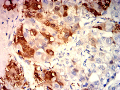 Figure 6: Immunohistochemical analysis of paraffin-embedded liver cancer tissues using ARG1 mouse mAb with DAB staining.