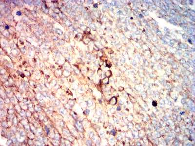 Figure 7: Immunohistochemical analysis of paraffin-embedded ovarian cancer tissues using SERPINA mouse mAb with DAB staining.