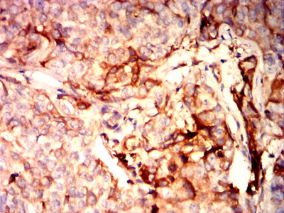 Figure 6: Immunohistochemical analysis of paraffin-embedded bladder cancer tissues using SERPINA mouse mAb with DAB staining.