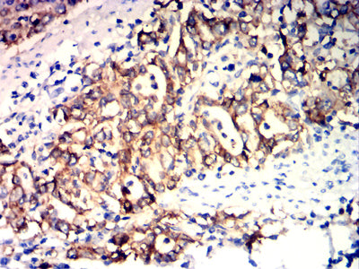 Figure 7: Immunohistochemical analysis of paraffin-embedded stomach cancer tissues using EPCAM mouse mAb with DAB staining.