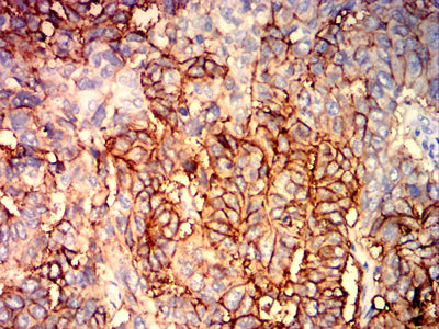 Figure 6: Immunohistochemical analysis of paraffin-embedded lung cancer tissues using EPCAM mouse mAb with DAB staining.