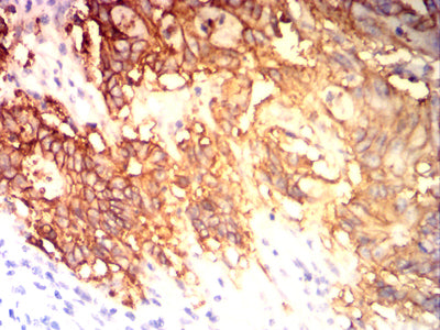 Figure 7: Immunohistochemical analysis of paraffin-embedded colon cancer tissues using EPCAM mouse mAb with DAB staining.