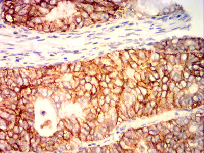 Figure 6: Immunohistochemical analysis of paraffin-embedded cervical cancer tissues using EPCAM mouse mAb with DAB staining.