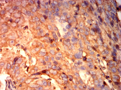 Figure 7: Immunohistochemical analysis of paraffin-embedded ovarian cancer tissues using TUBA4A mouse mAb with DAB staining.