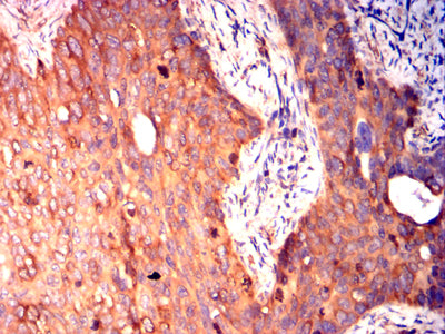 Figure 6: Immunohistochemical analysis of paraffin-embedded cervical cancer tissues using TUBA4A mouse mAb with DAB staining.