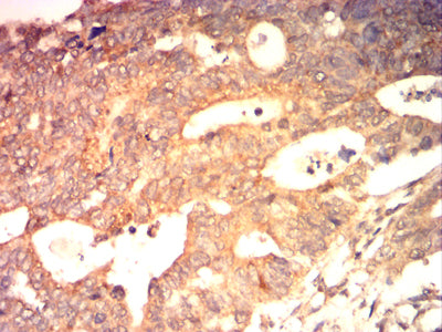 Figure 8: Immunohistochemical analysis of paraffin-embedded colon cancer tissues using BAX mouse mAb with DAB staining.