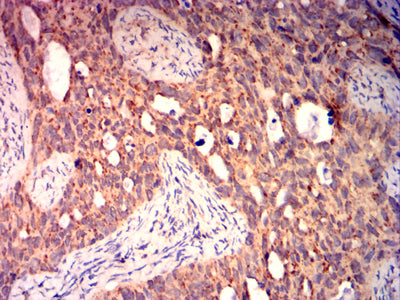 Figure 7: Immunohistochemical analysis of paraffin-embedded cervical cancer tissues using BAX mouse mAb with DAB staining.