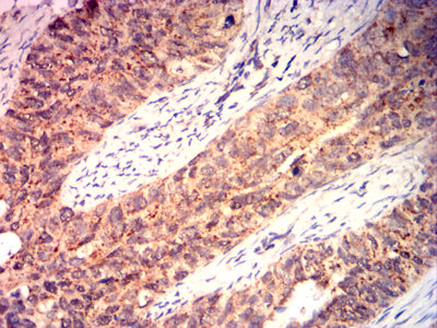 Figure 7: Immunohistochemical analysis of paraffin-embedded cervical cancer tissues using BAX mouse mAb with DAB staining.