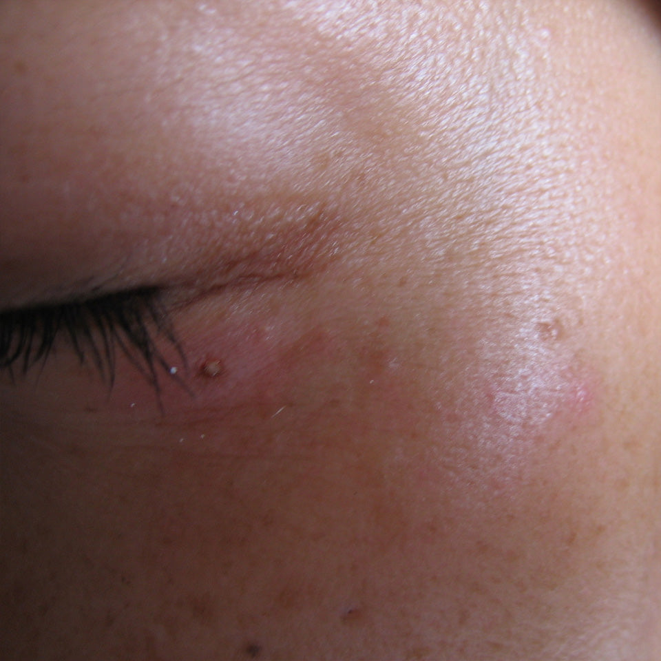 Keiko - Syringoma - 20 Minutes After Treatment