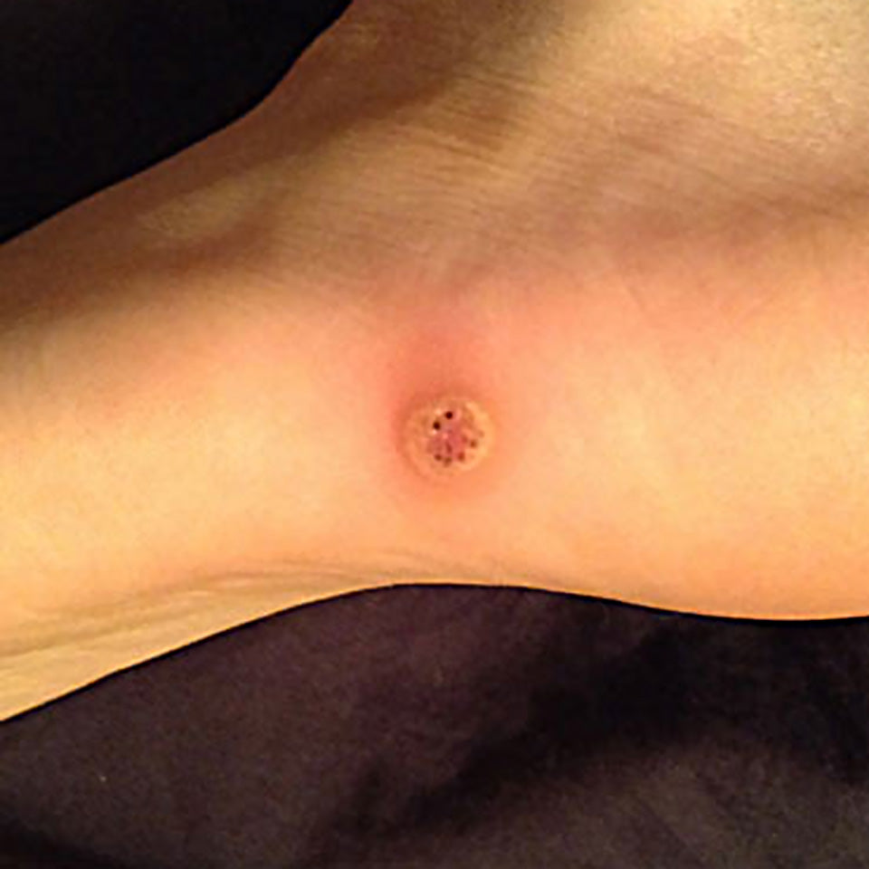 Chely's Son Plantar Wart - After