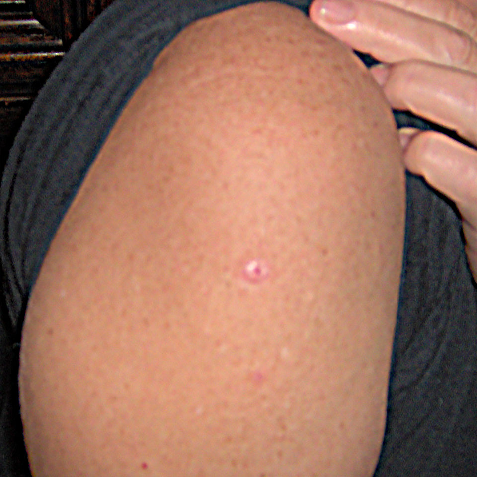 Eva - Large Skin Tag on Arm - After