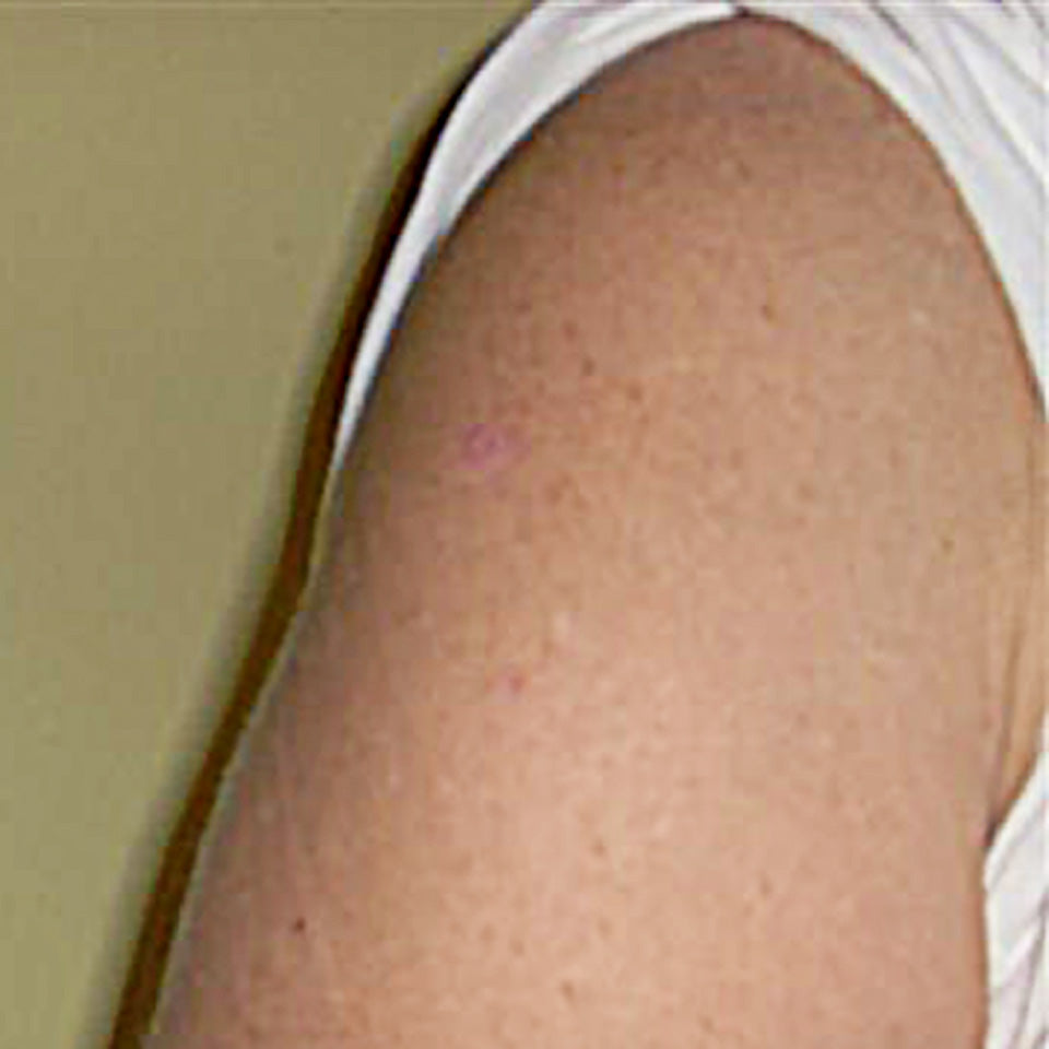 Eva - Large Skin Tag on Arm - After