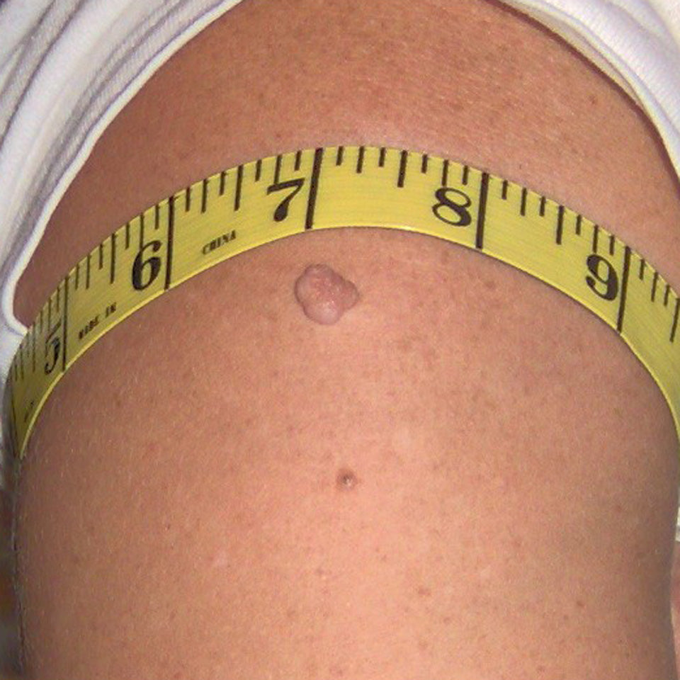 Eva - Large Skin Tag on Arm - Before