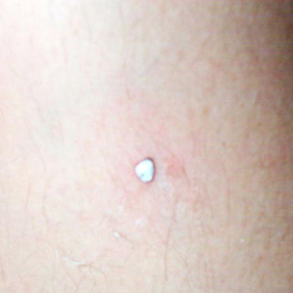 Jason - Arm Wart - During