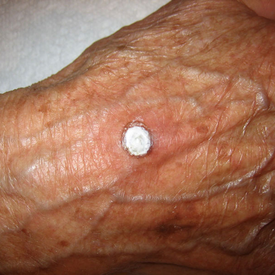 Mom - Hand Wart - Cream Applied