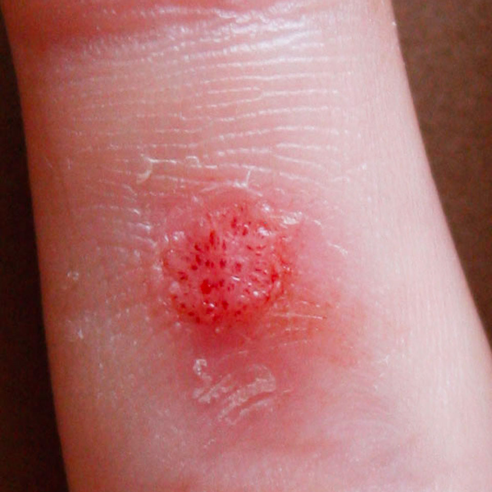 Hand Wart Removal using Wart & Mole Vanish - Callus Removed