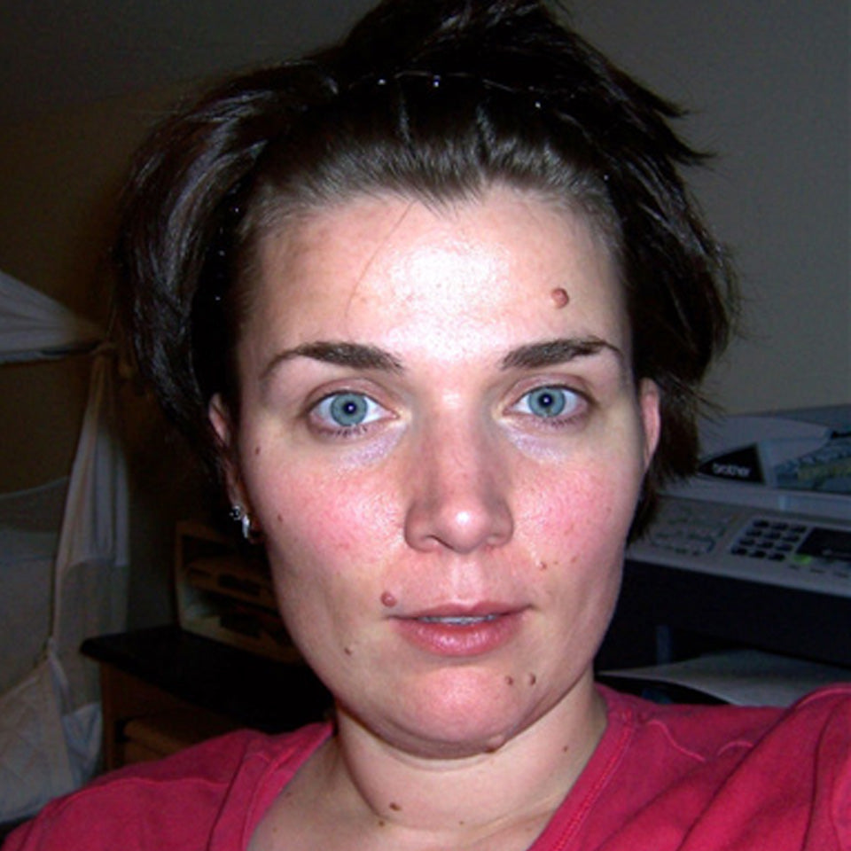 Rachel - Multiple Face Moles Removal using Wart & Mole Vanish - Before