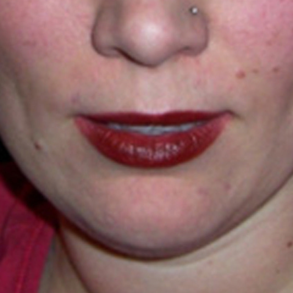 Rachel - Multiple Face Moles Removal using Wart & Mole Vanish - Lip & Chin After