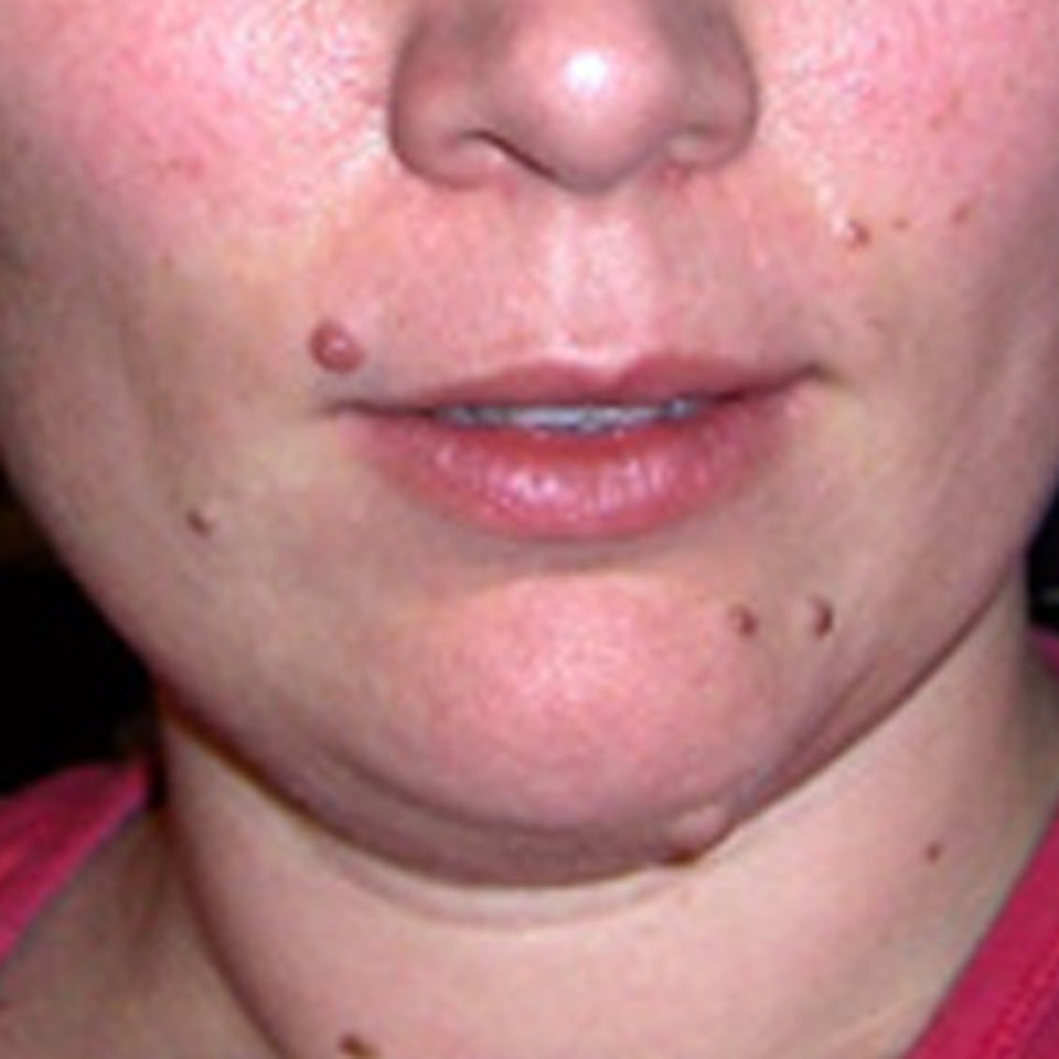 Rachel - Multiple Face Moles Removal using Wart & Mole Vanish - Lip & Chin Before