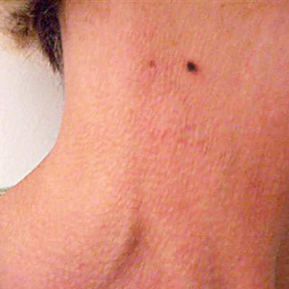 Shirley - Neck Skin Tag - After 10 Days
