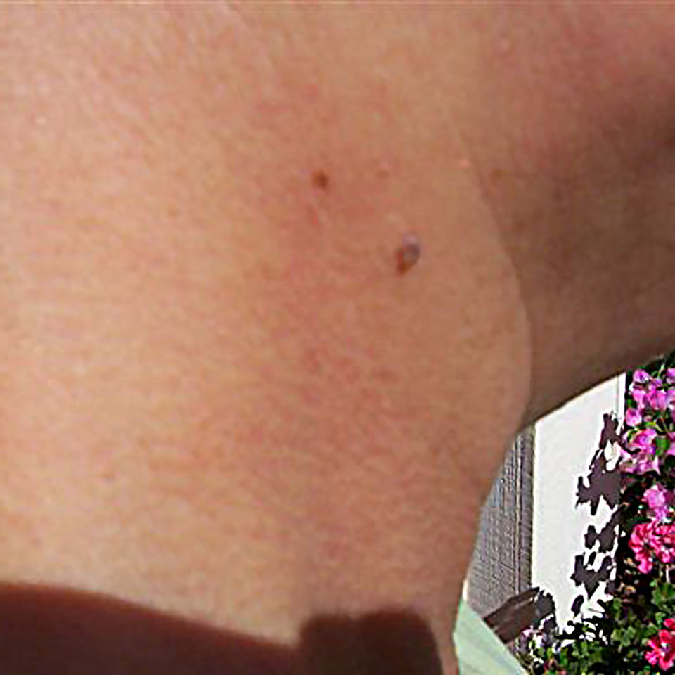 Shirley - Neck Skin Tag - Before