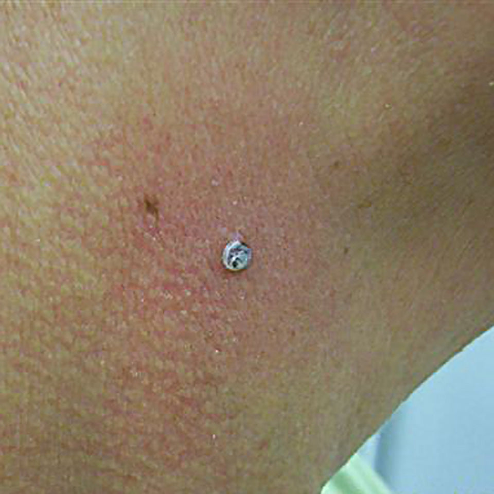 Shirley - Neck Skin Tag - During