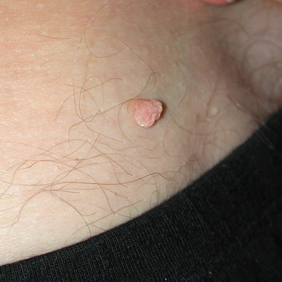Tom - Skin Tag Removal using Wart & Mole Vanish - Before