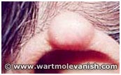 Ear Mole Removal - Before