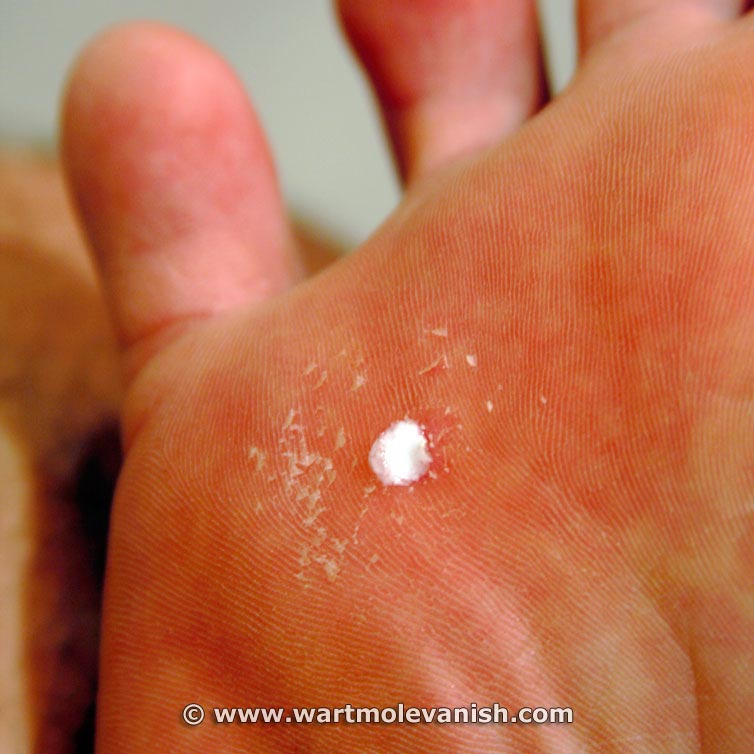 Josh - Plantar Wart - During Treatment