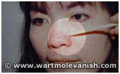 Nose Mole - After