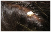 Head Mole - During Treatment