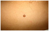 Chely - Skin Tag - Before