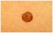 Chely - Skin Tag - Before Close Up