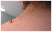 Chely - Skin Tag - Before Side View
