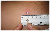 Chely - Skin Tag - 1st Treatment