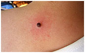 Chely - Skin Tag - 2nd Treatment