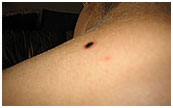 Chely - Skin Tag - Next Day After Treatment