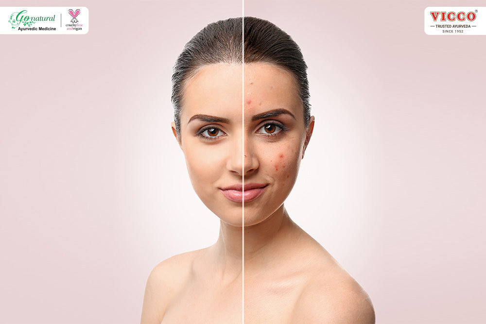 Make Healthy Changes in Your Lifestyle to Repair Damaged Skin  Vicco Labs