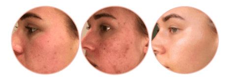 green herbs skin peel before and after image