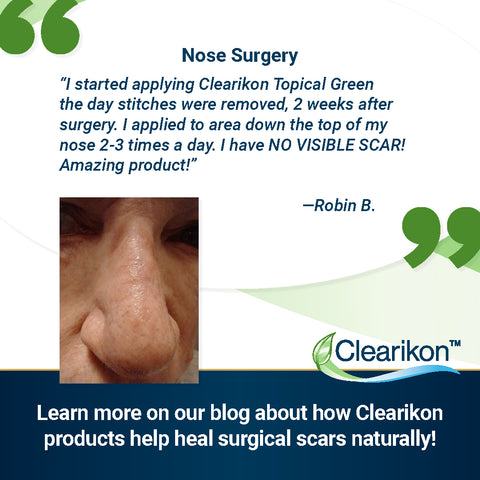 Learn more on our blog about how Clearikon products help heal surgical scars naturally! Image has a customer testimonial on it about how her nose healed with no visible scar.